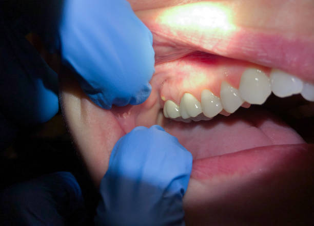 Best Emergency Tooth Extraction in New Bern, NC