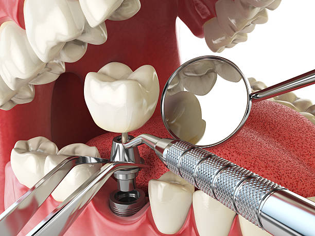 Best Emergency Wisdom Teeth Removal in New Bern, NC
